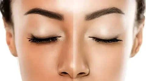 Permanent Skin Whitening Treatment in Islamabad